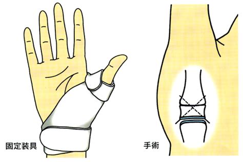 右手拇指|「母指CM関節症」｜日本整形外科学会 症状・病気をしらべ